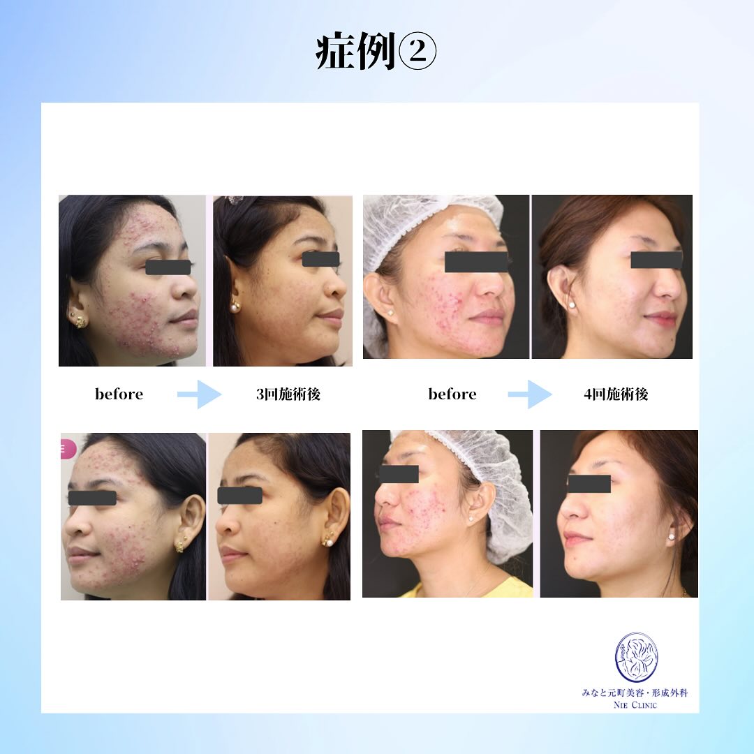 アドバテックスレーザー導入前のお知らせ