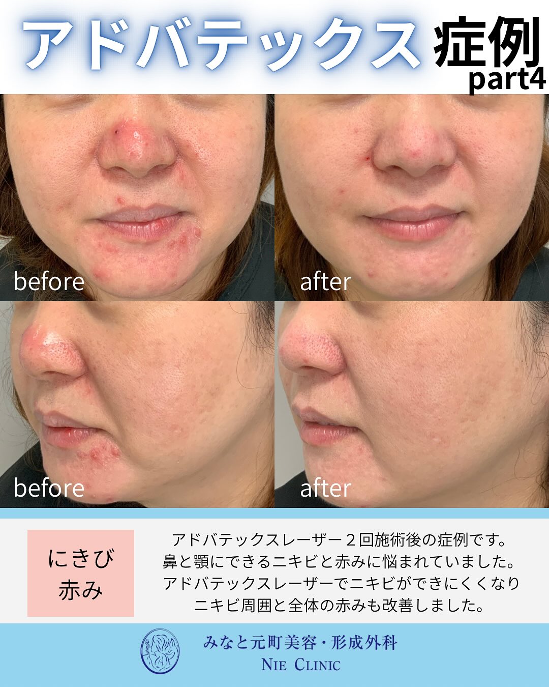 アドバテックスレーザー治療のご紹介
