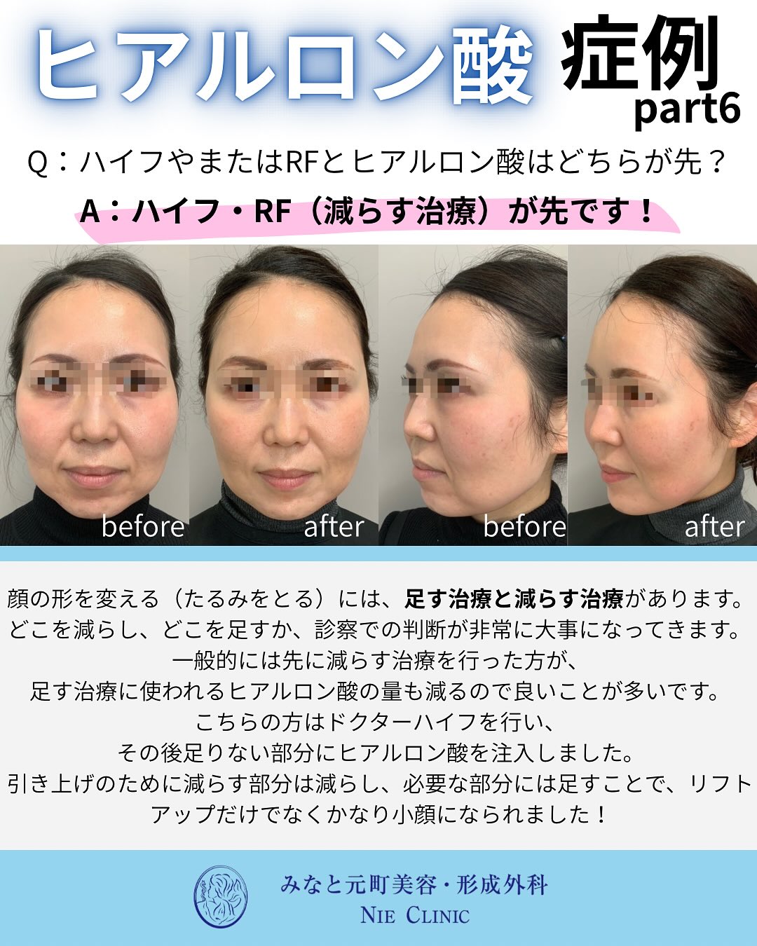 ヒアルロン酸施術のご紹介