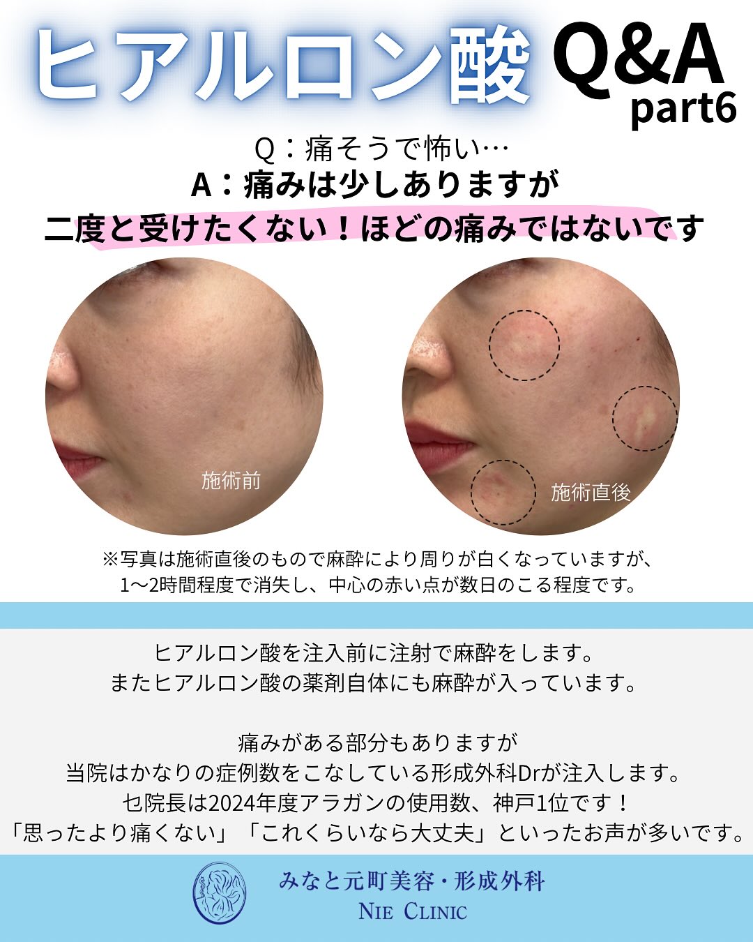 ヒアルロン酸のよくある質問