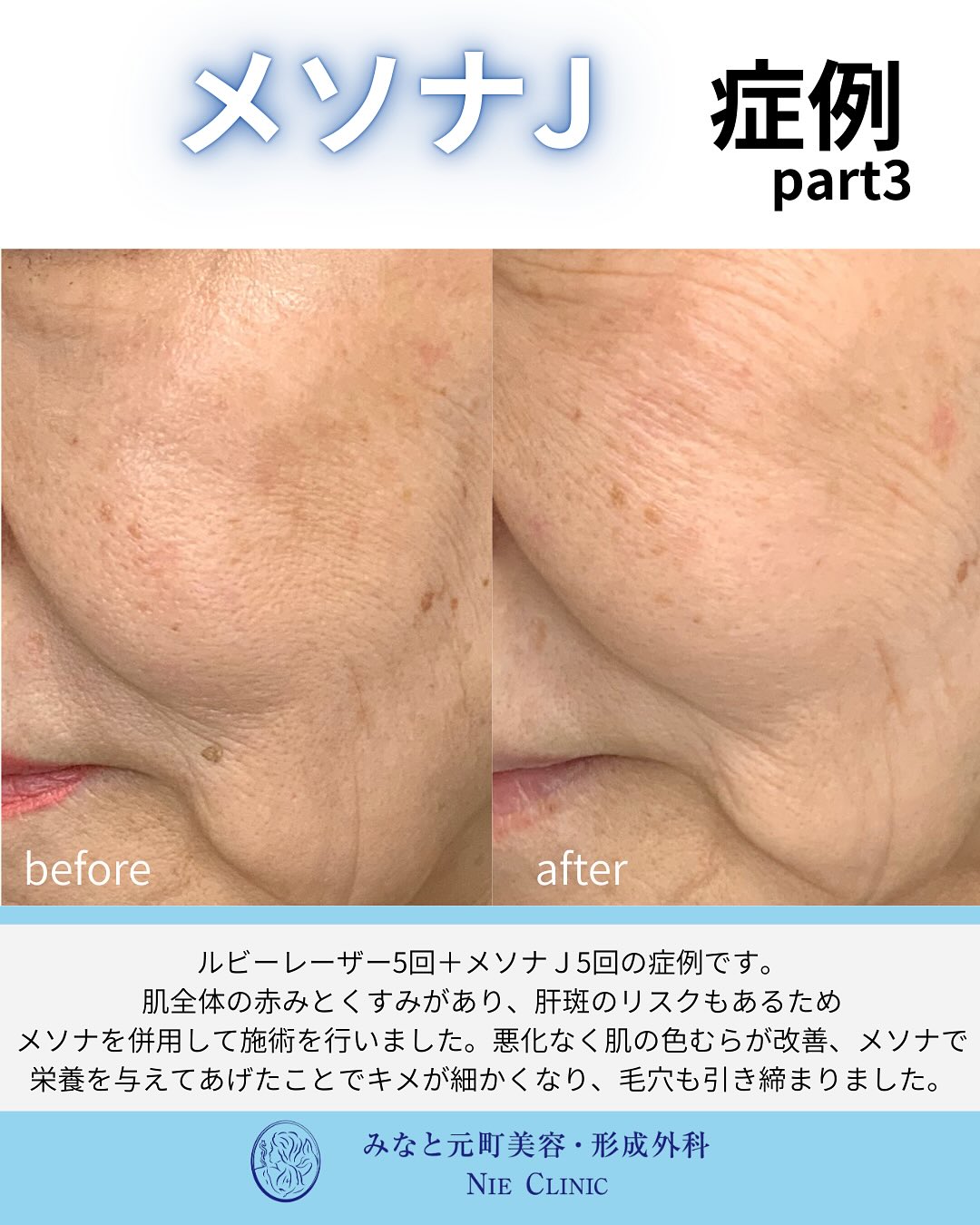 メソナJのご紹介