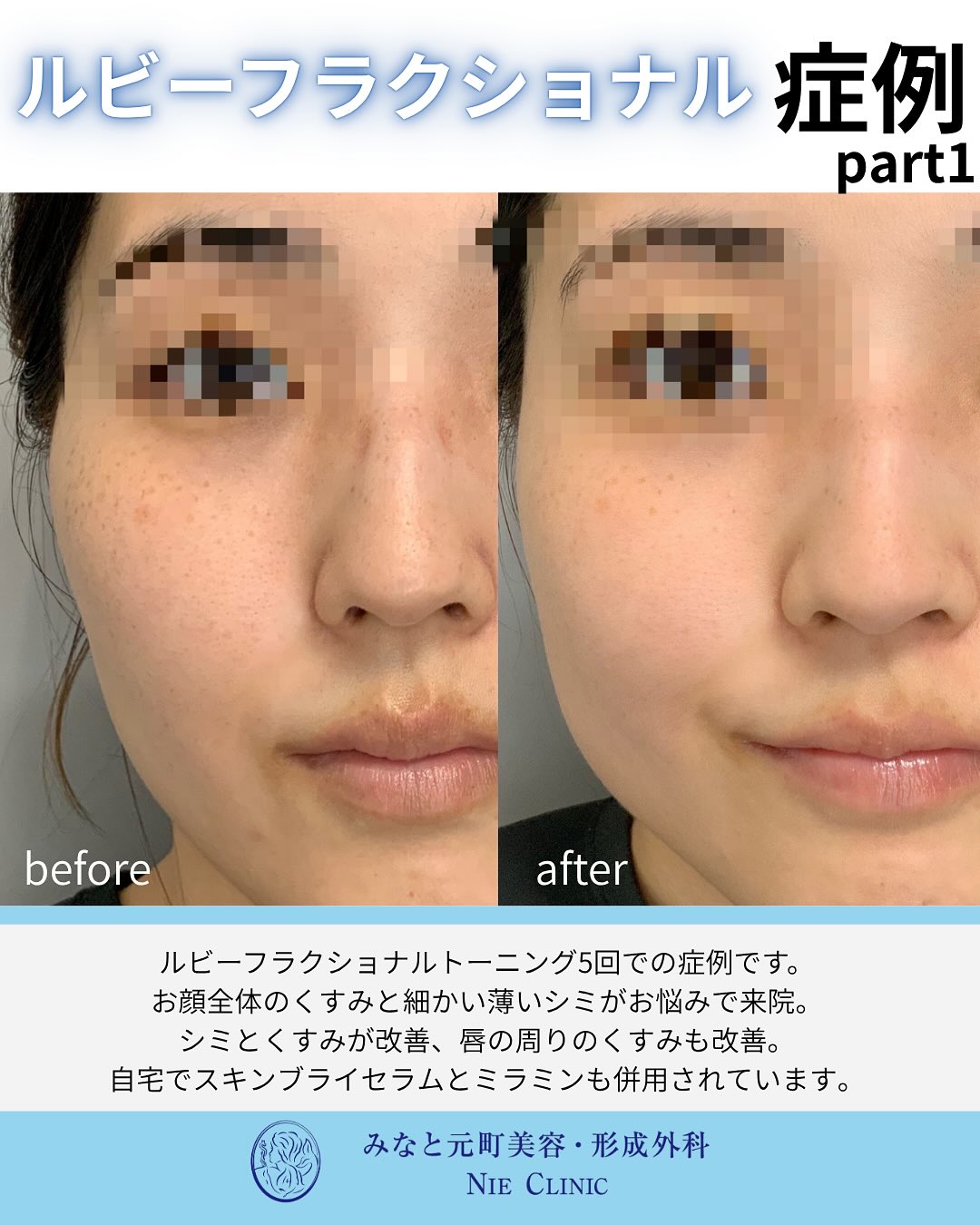 ルビーフラクショナルのご紹介