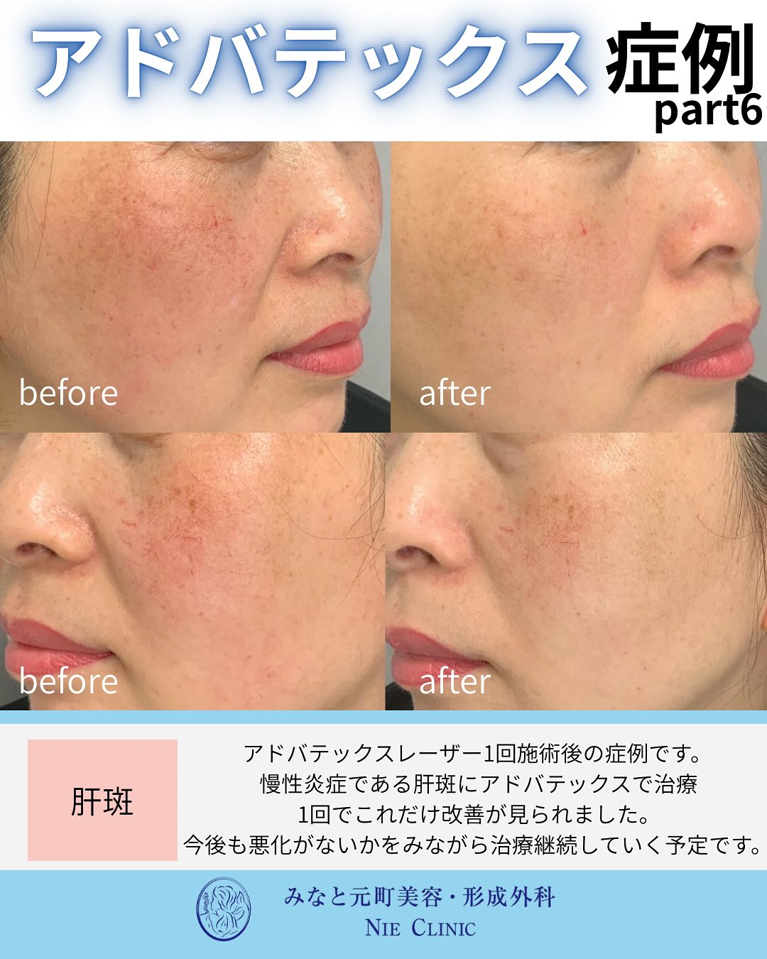 アドバテックスレーザー治療のご紹介