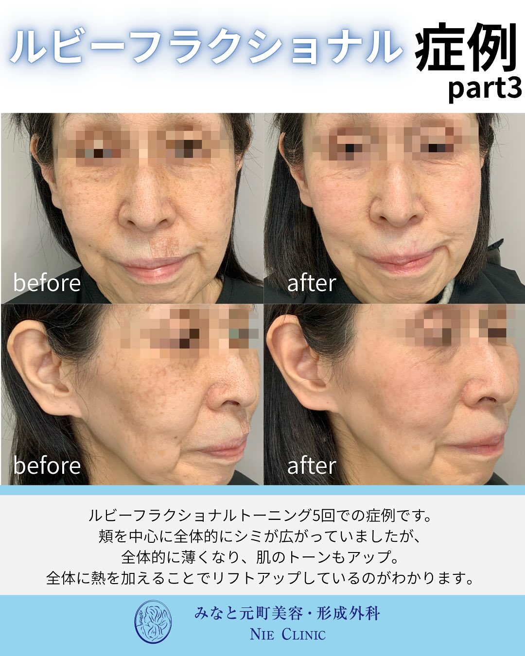 ルビーフラクショナルのご紹介