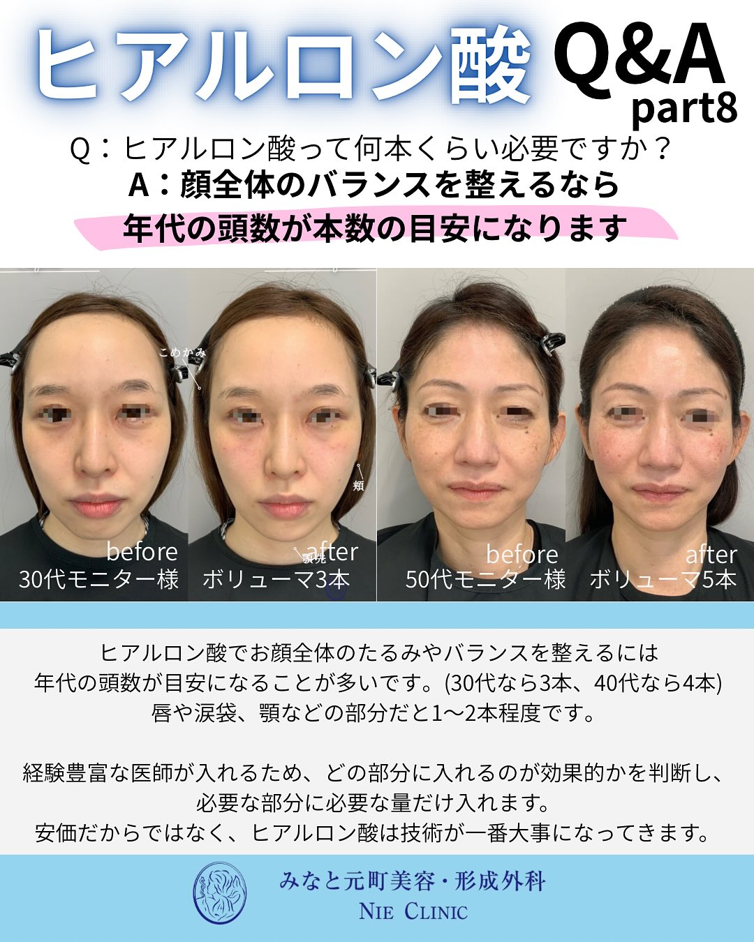 ヒアルロン酸のよくある質問