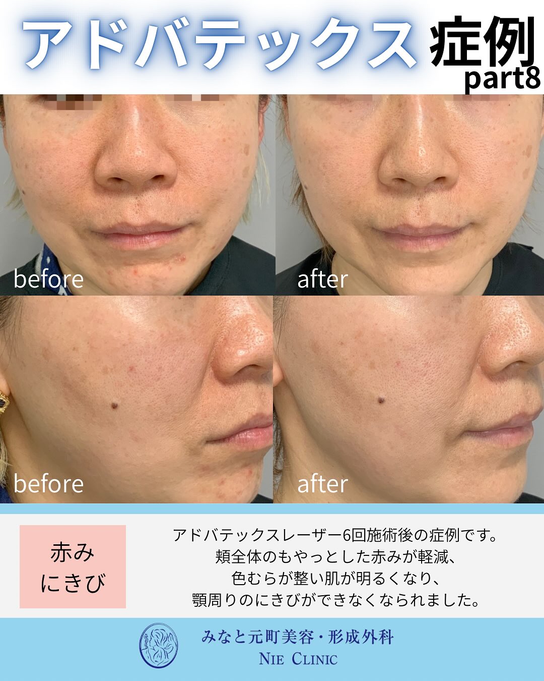 アドバテックスレーザー治療のご紹介