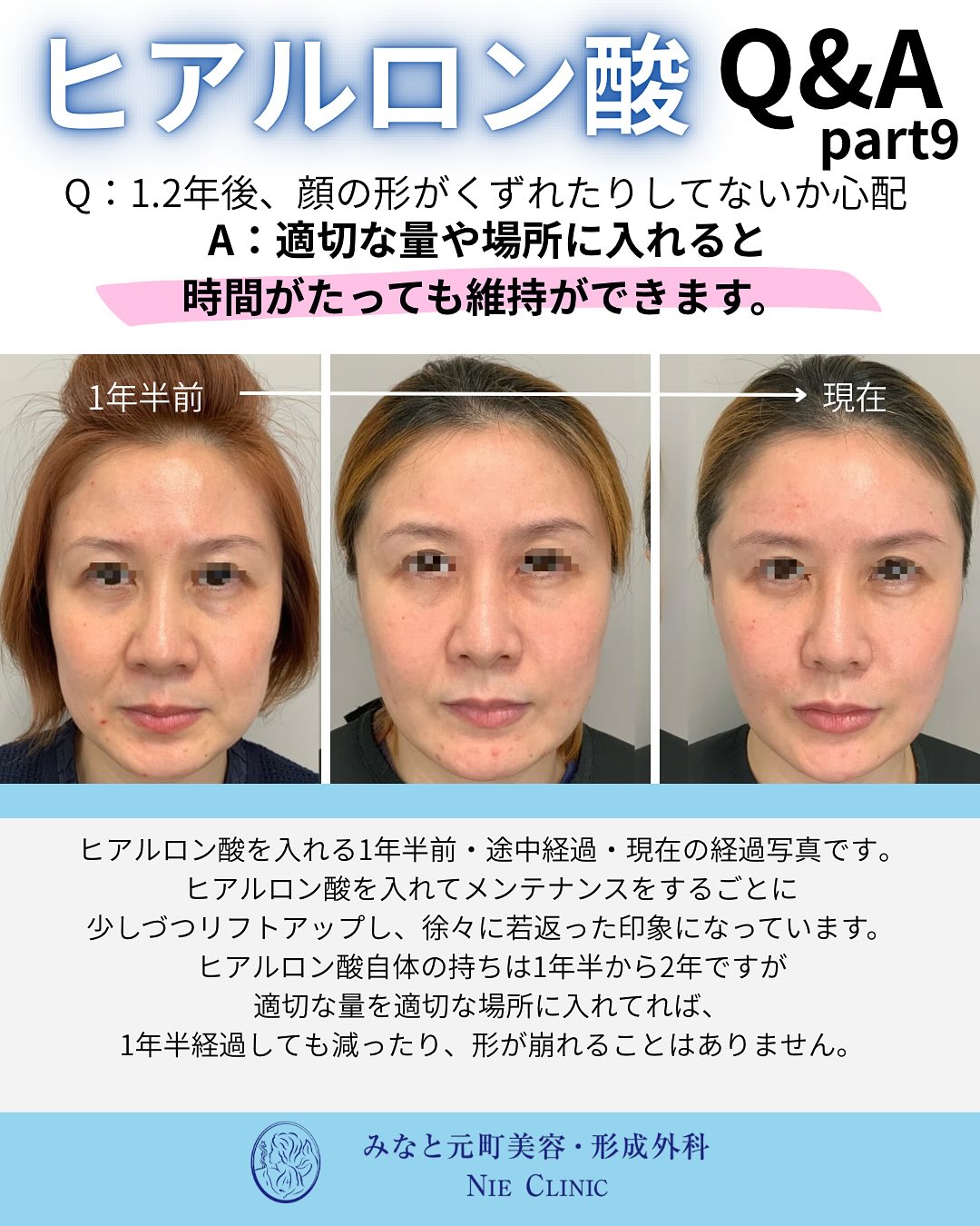 ヒアルロン酸のよくある質問