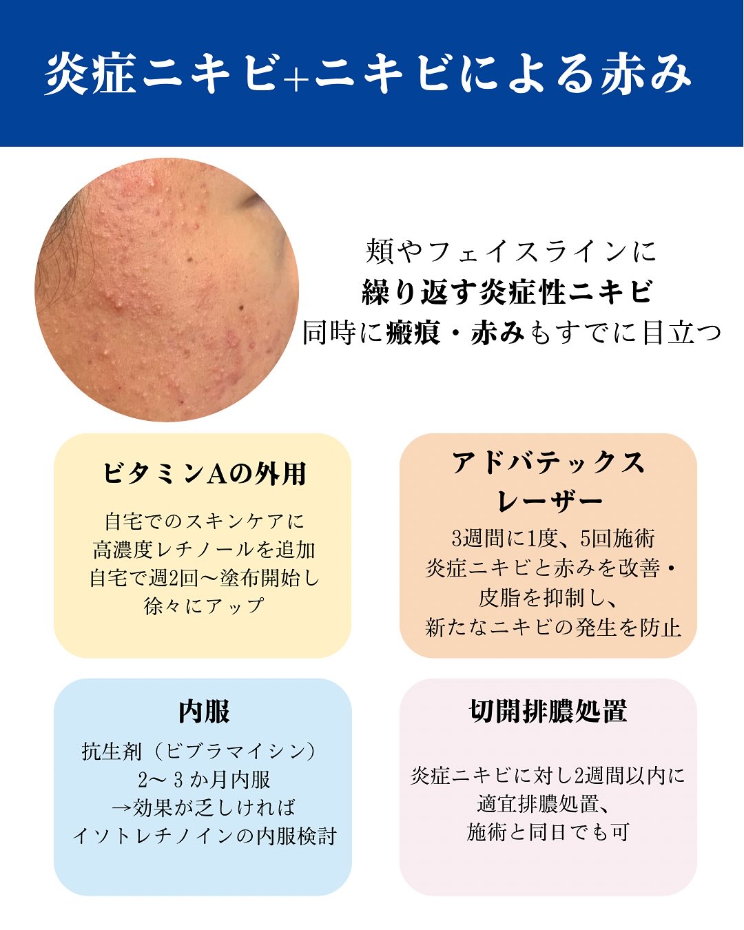 ニキビ治療のご紹介