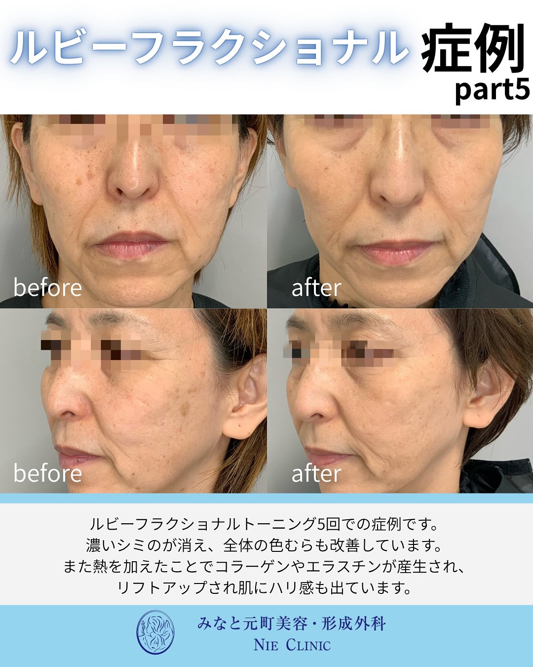 ルビーフラクショナルのご紹介