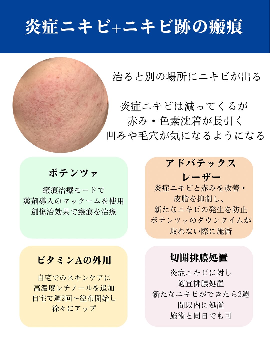 ニキビ治療のご紹介