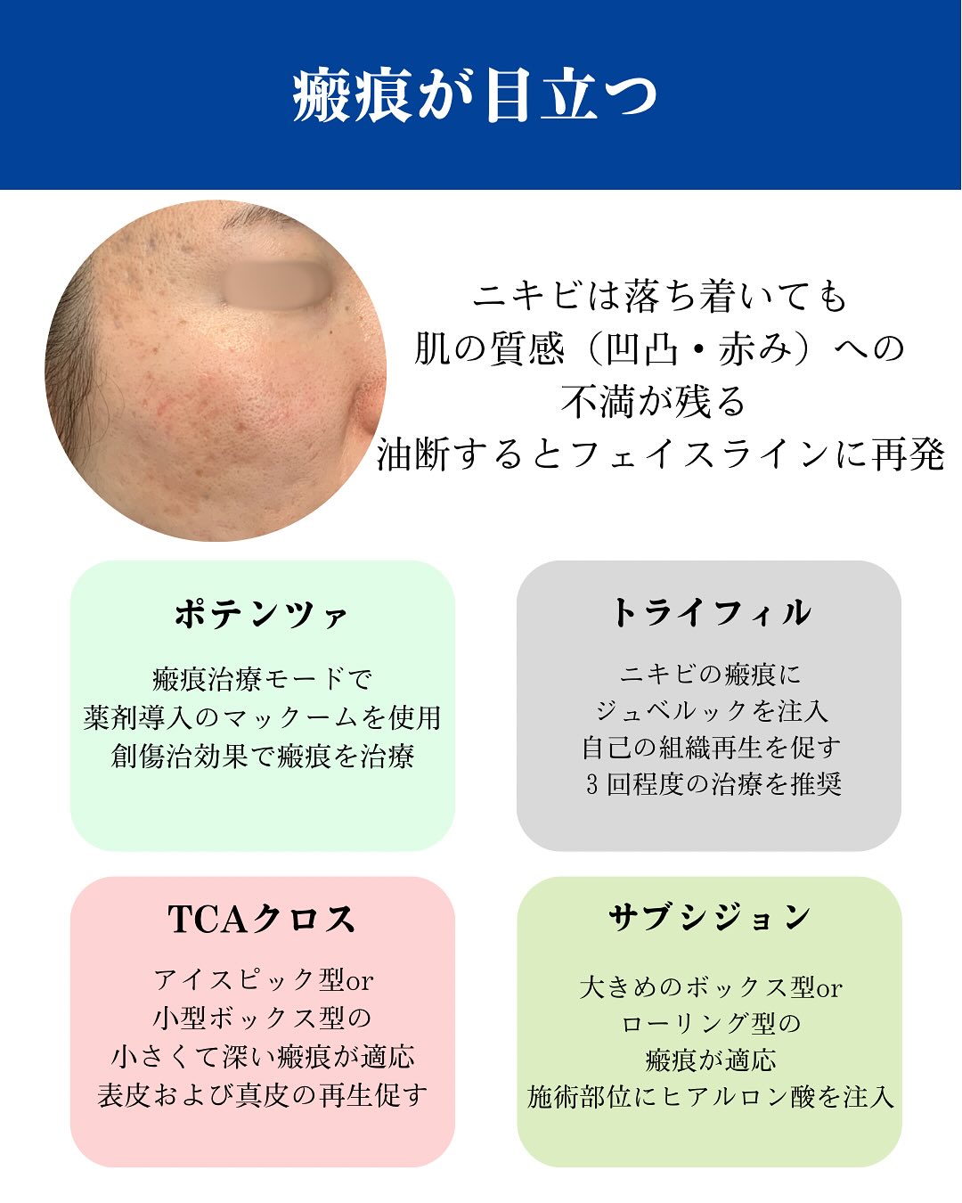 ニキビ治療のご紹介
