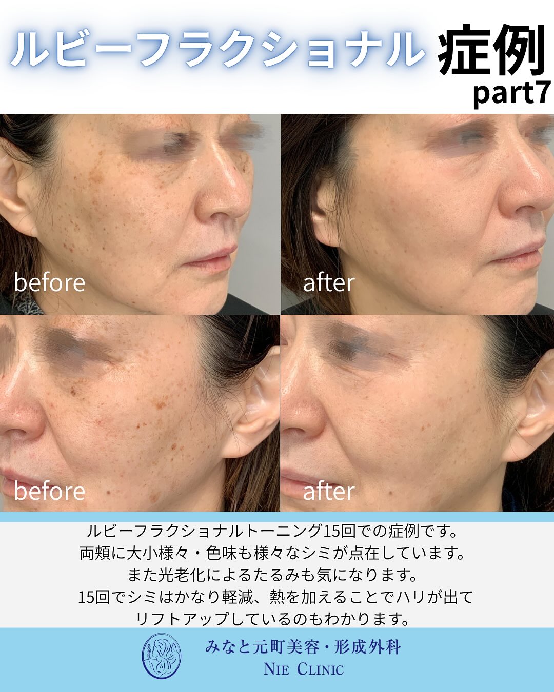 ルビーフラクショナルのご紹介