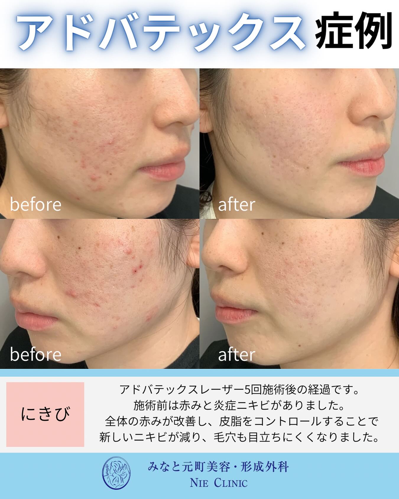 当院で大人気のアドバテックスレーザーの症例のご紹介です🫧