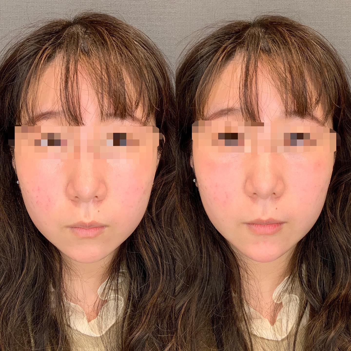 《ヒアルロン酸1cc✨》