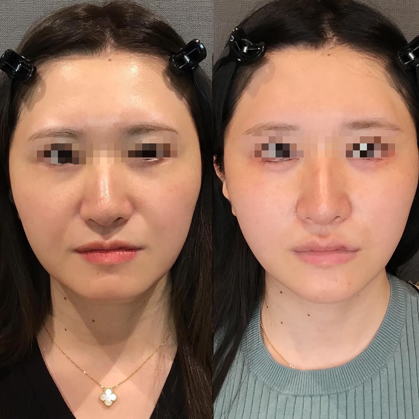 《ヒアルロン酸8cc✨》