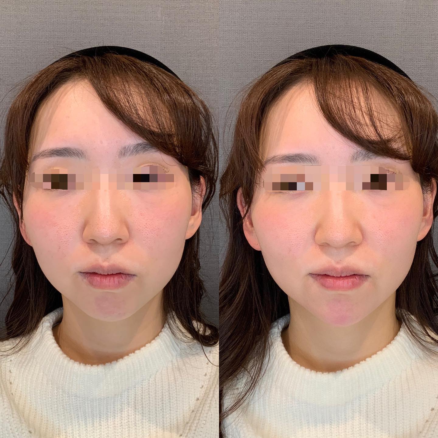 《ヒアルロン酸1cc✨》