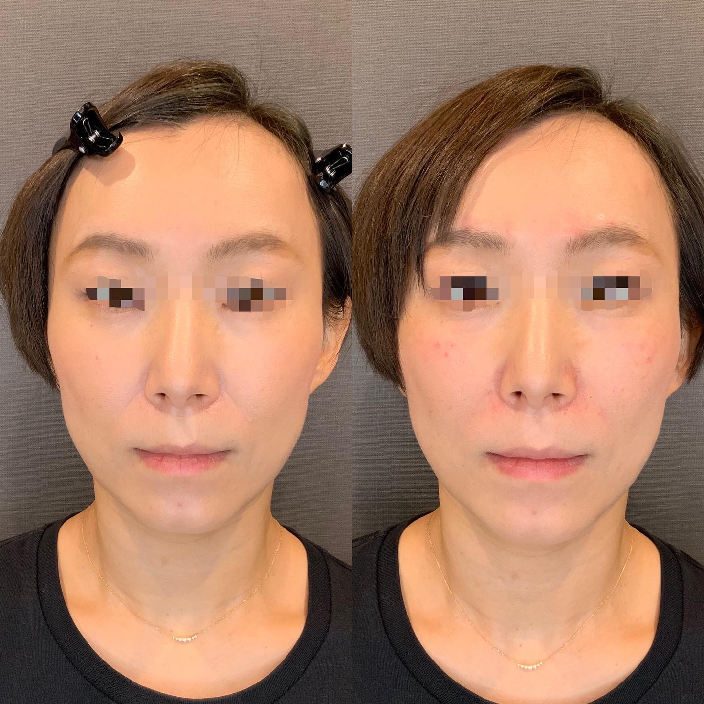 《ヒアルロン酸2cc✨》