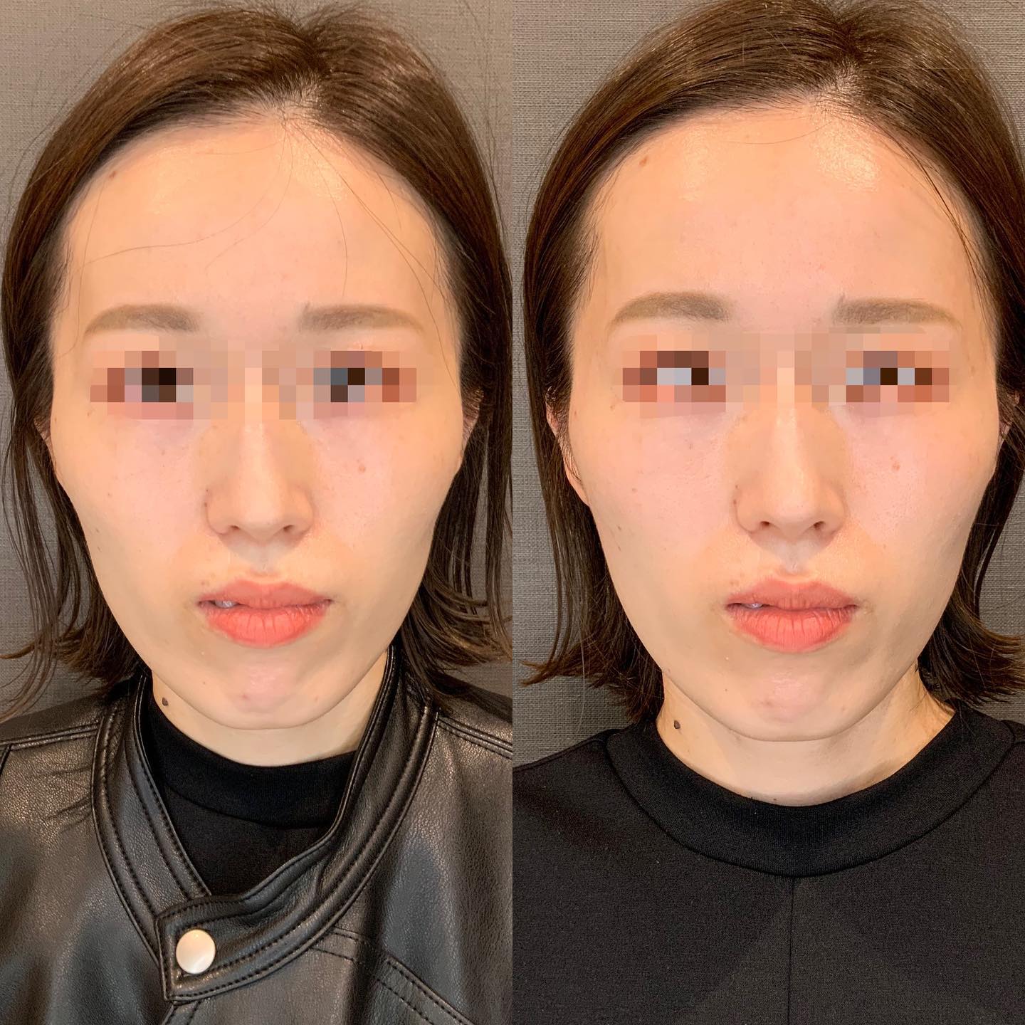 《ヒアルロン酸3cc✨》