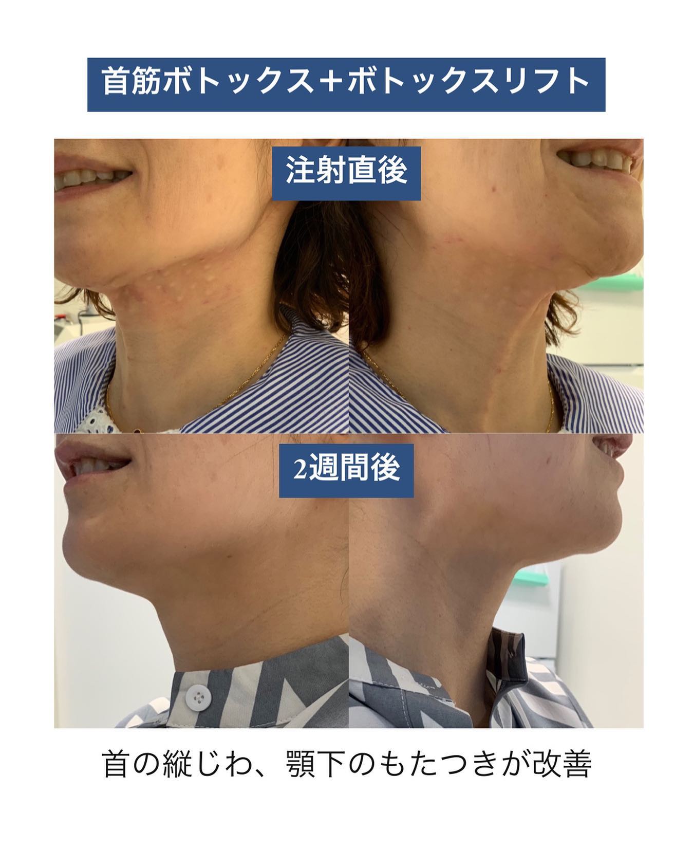 《首筋ボトックス+ボトックスリフト》