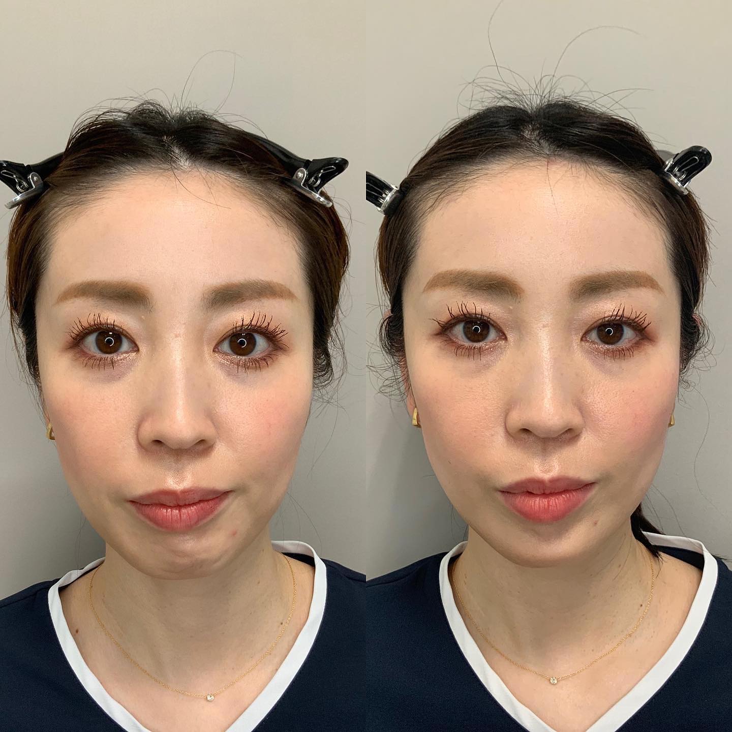 ☆ボトックス☆