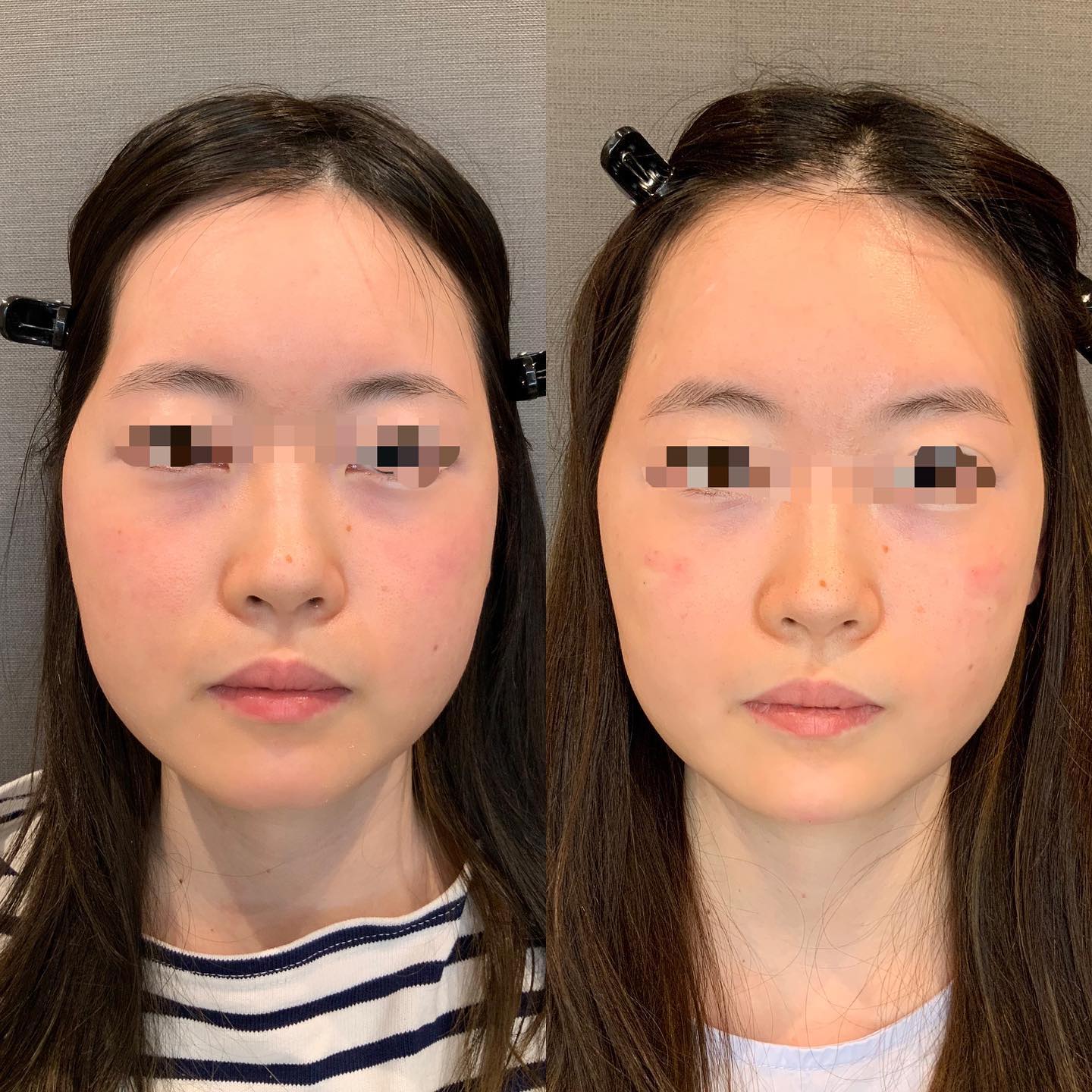 《ヒアルロン酸4cc✨》
