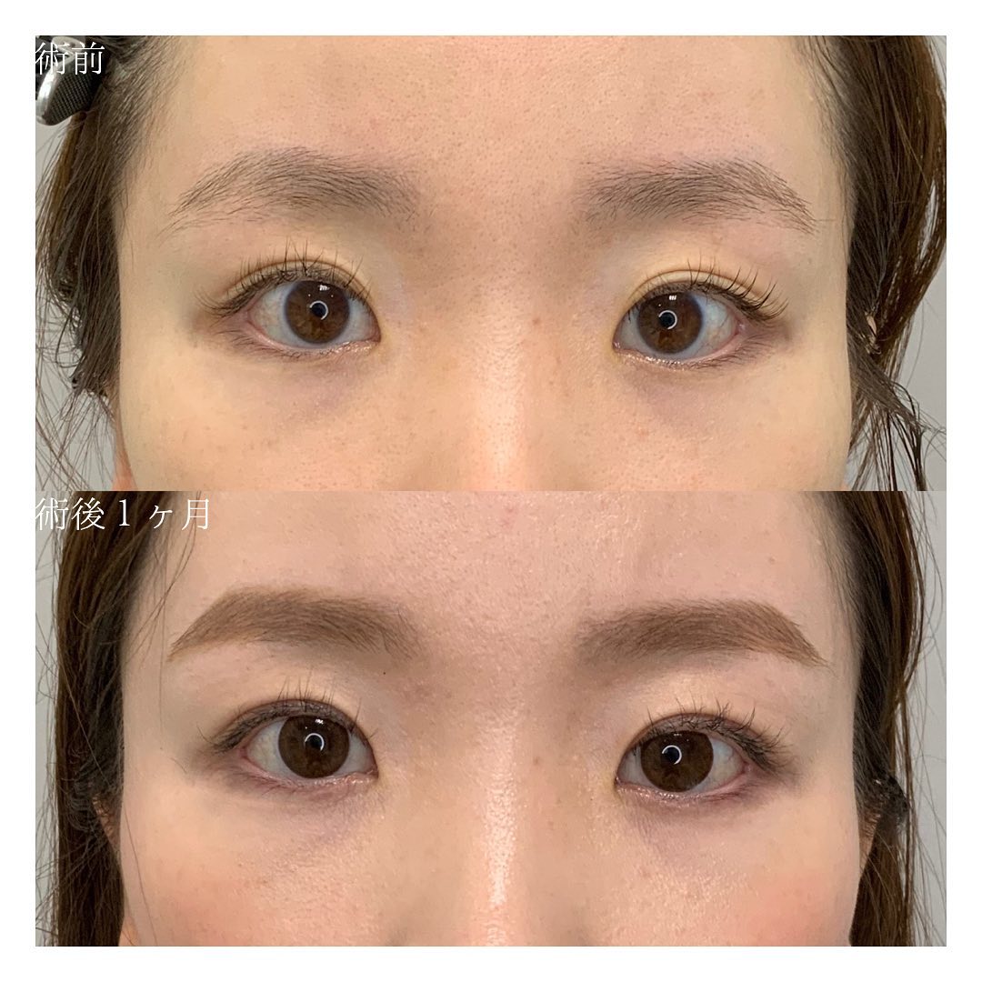二重形成・切開法