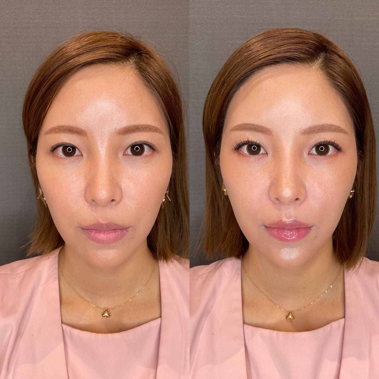 《ヒアルロン酸1.4cc》