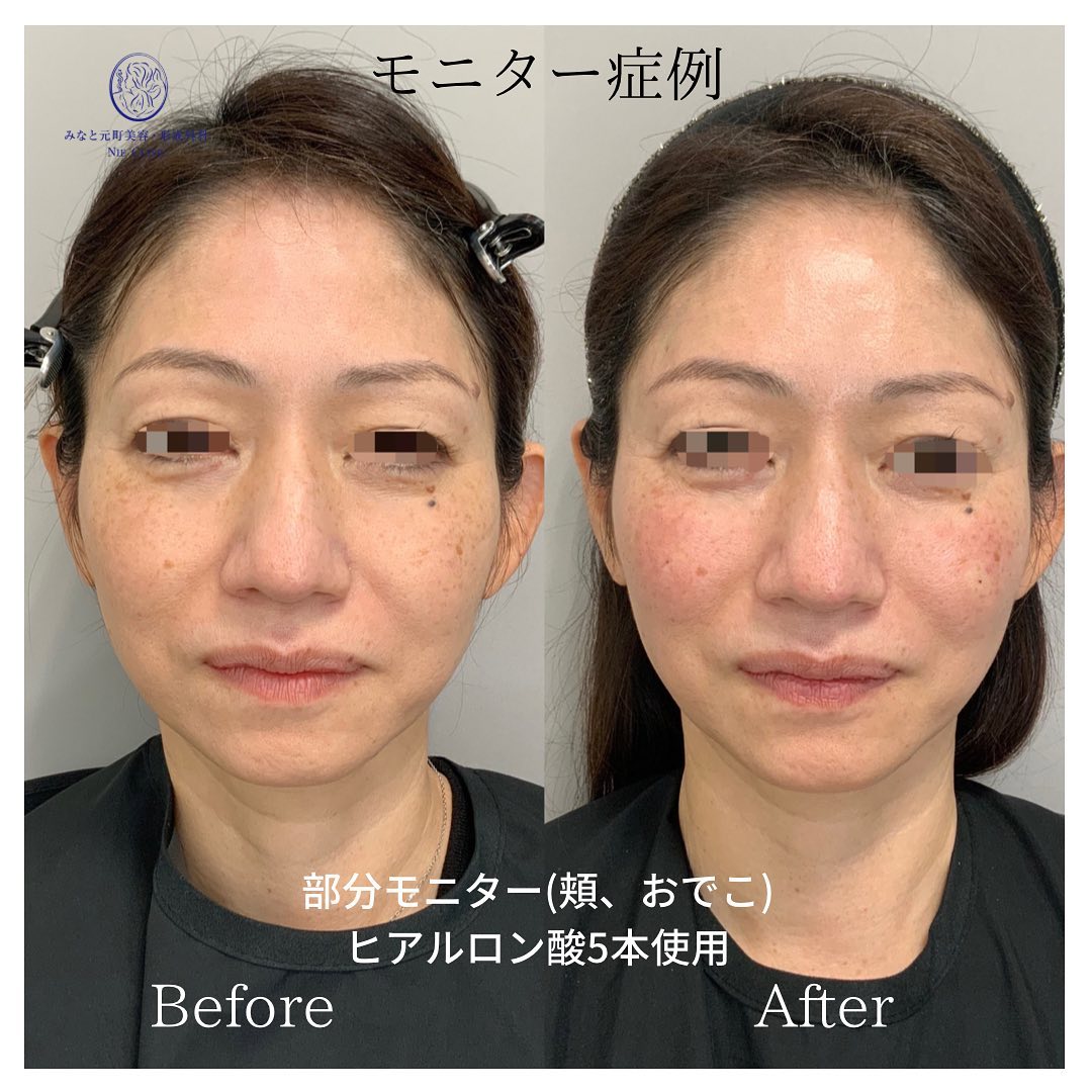 《ヒアルロン酸5cc》