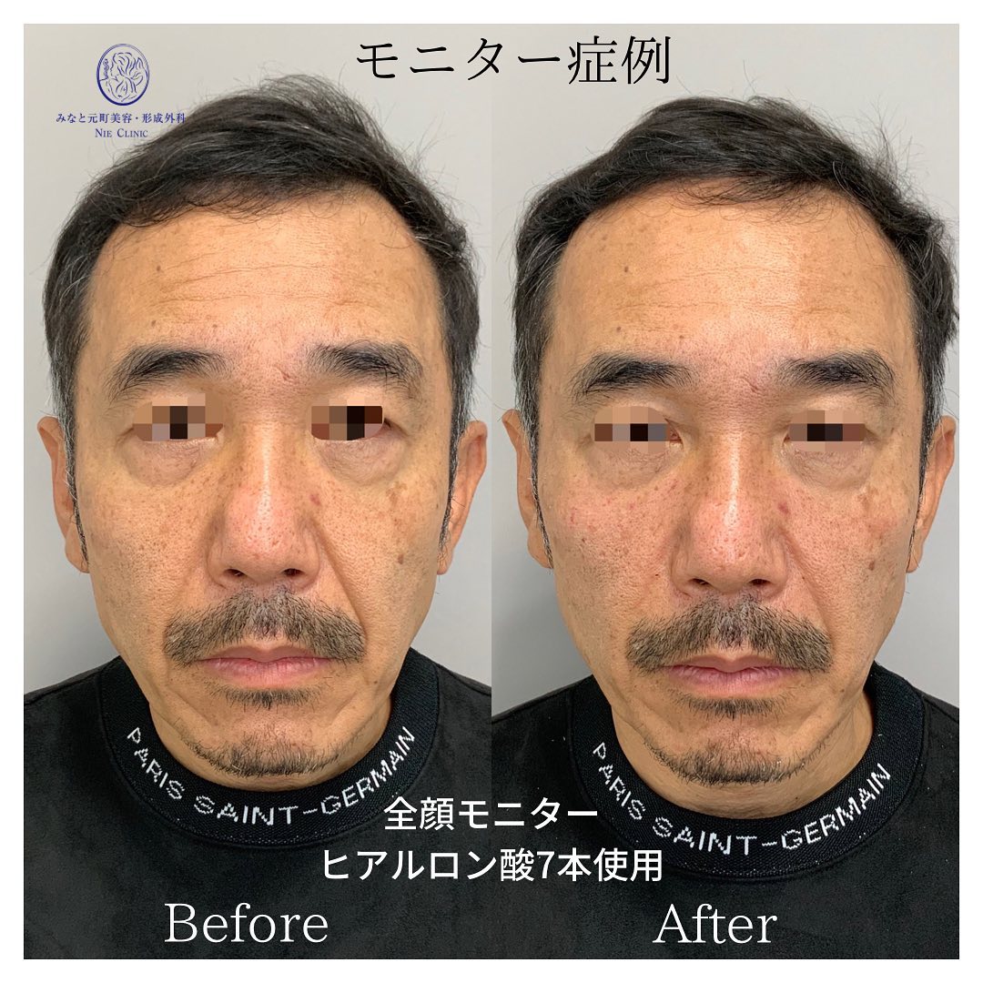 《ヒアルロン酸7cc》