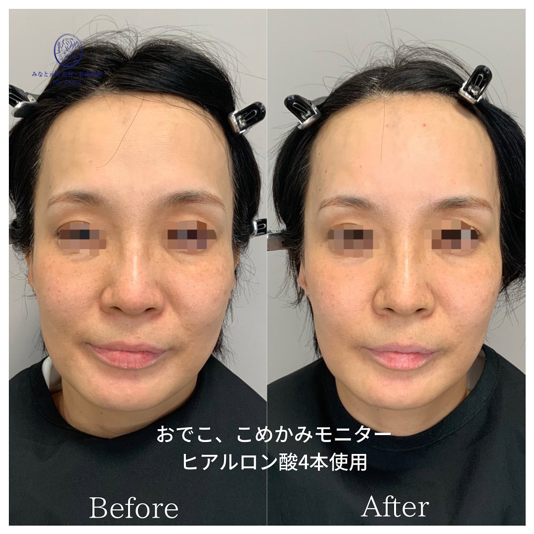 《ヒアルロン酸4cc》