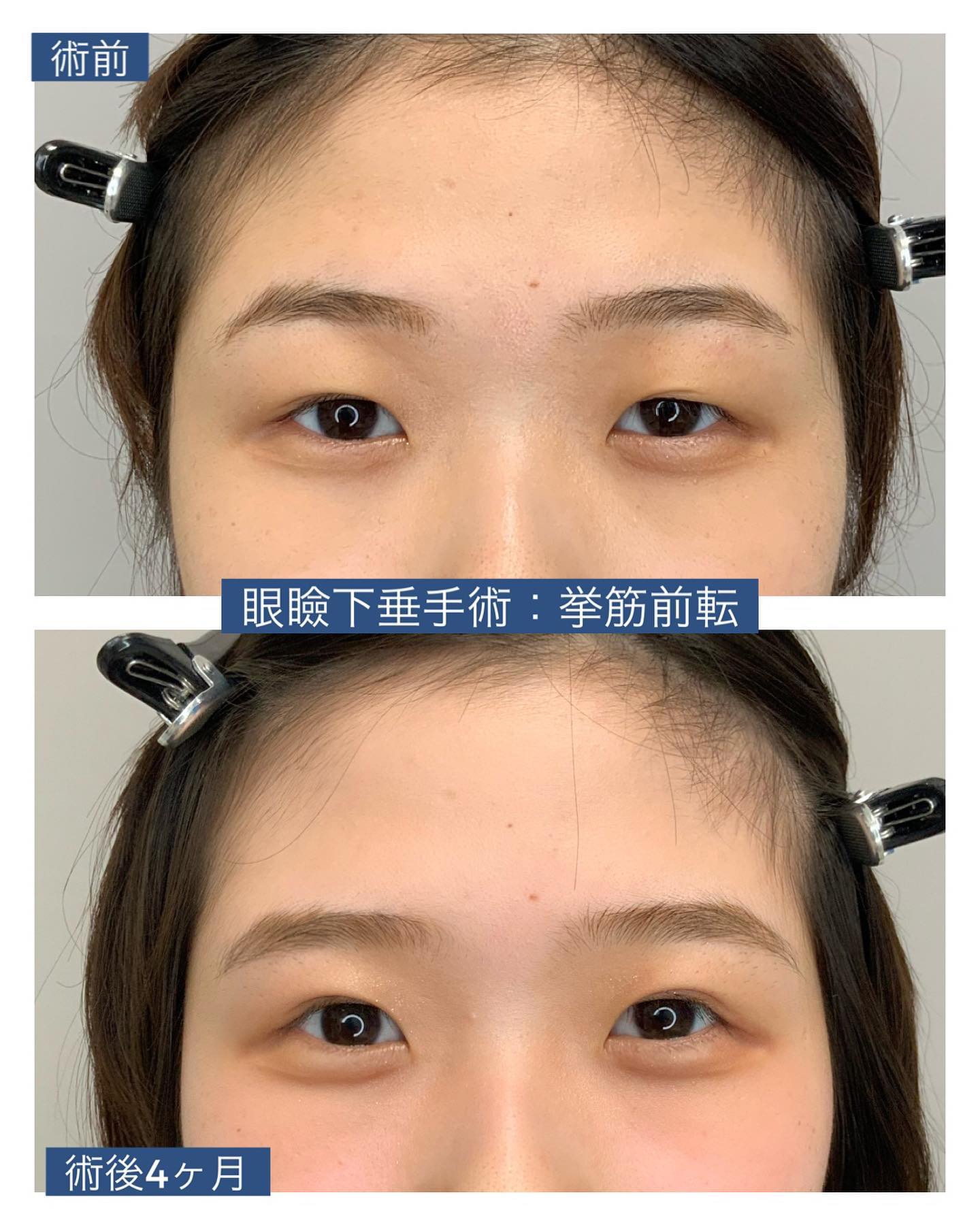 眼瞼下垂症手術:挙筋前転