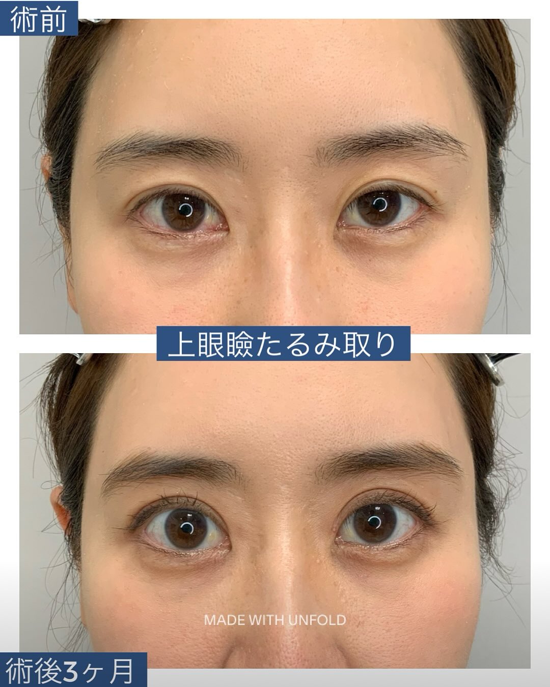 上眼瞼たるみ取り
