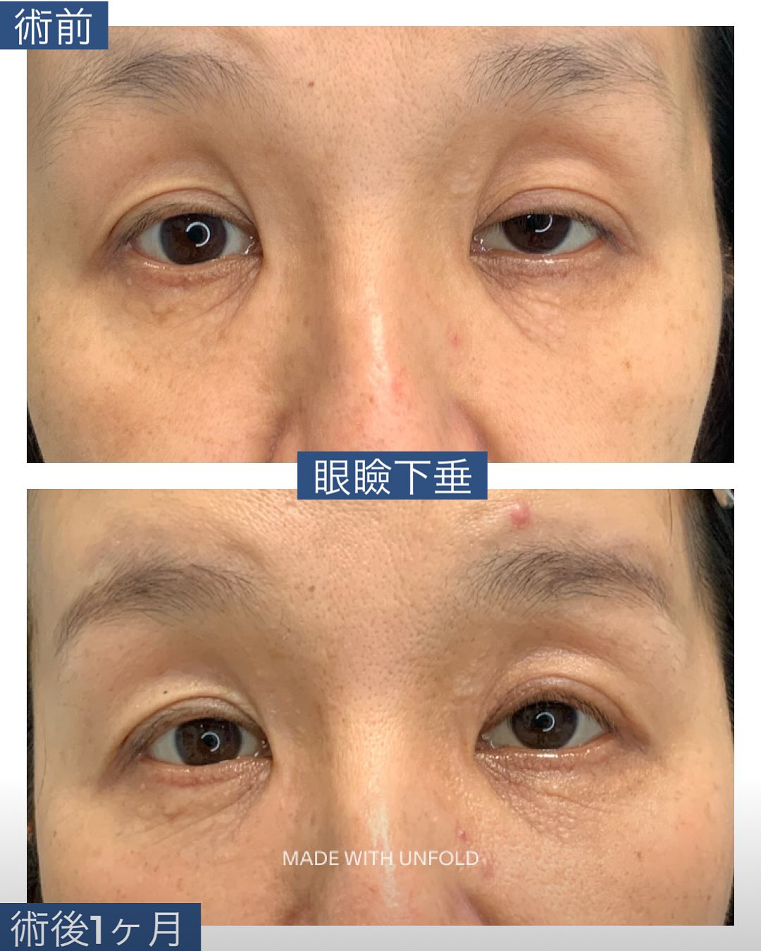 眼瞼下垂症手術:挙筋前転