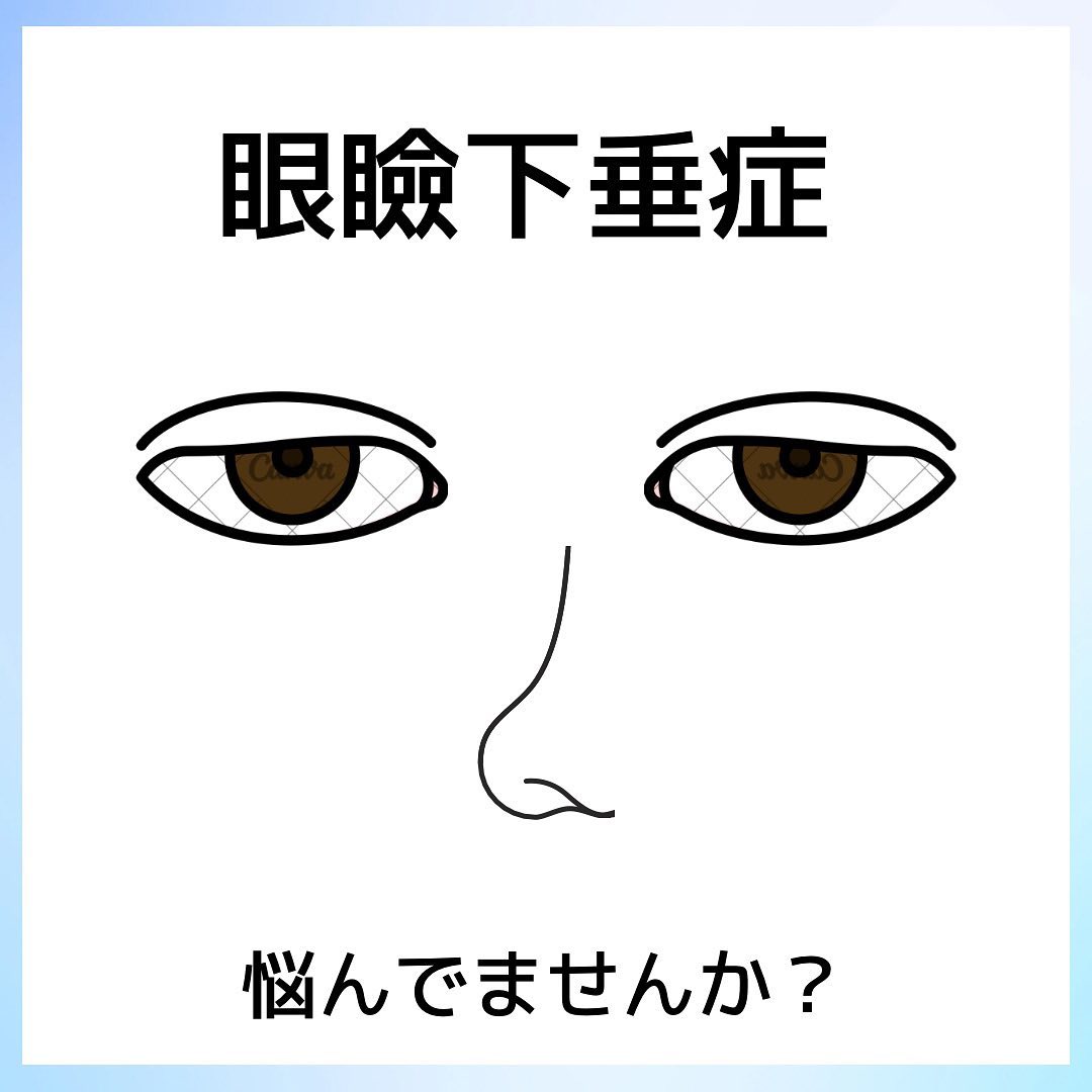 挙筋性眼瞼下垂の症状と手術適応を整理した画像