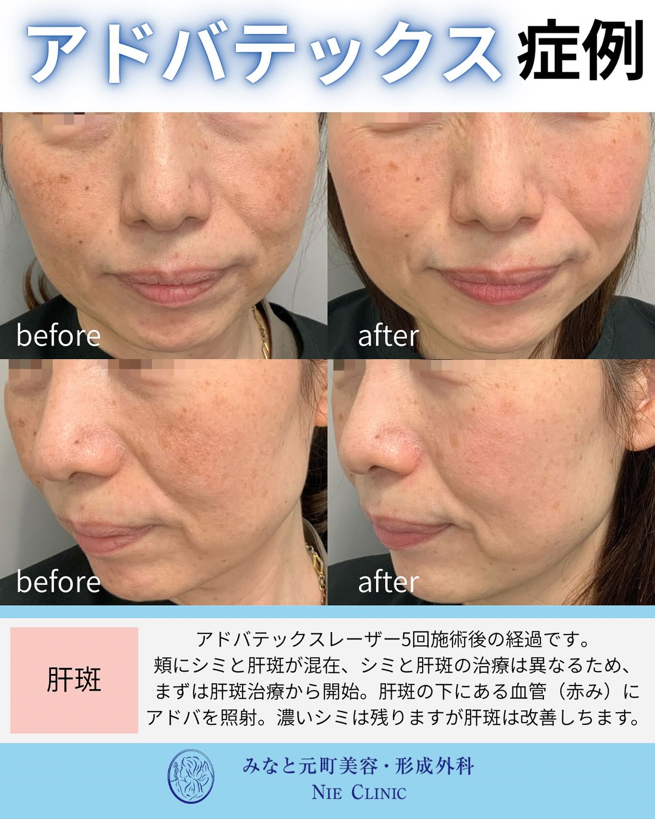 アドバテックスレーザー5回施術後の経過です。