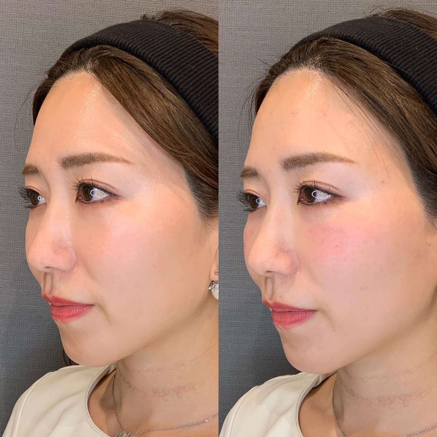 《ヒアルロン酸3cc✨》