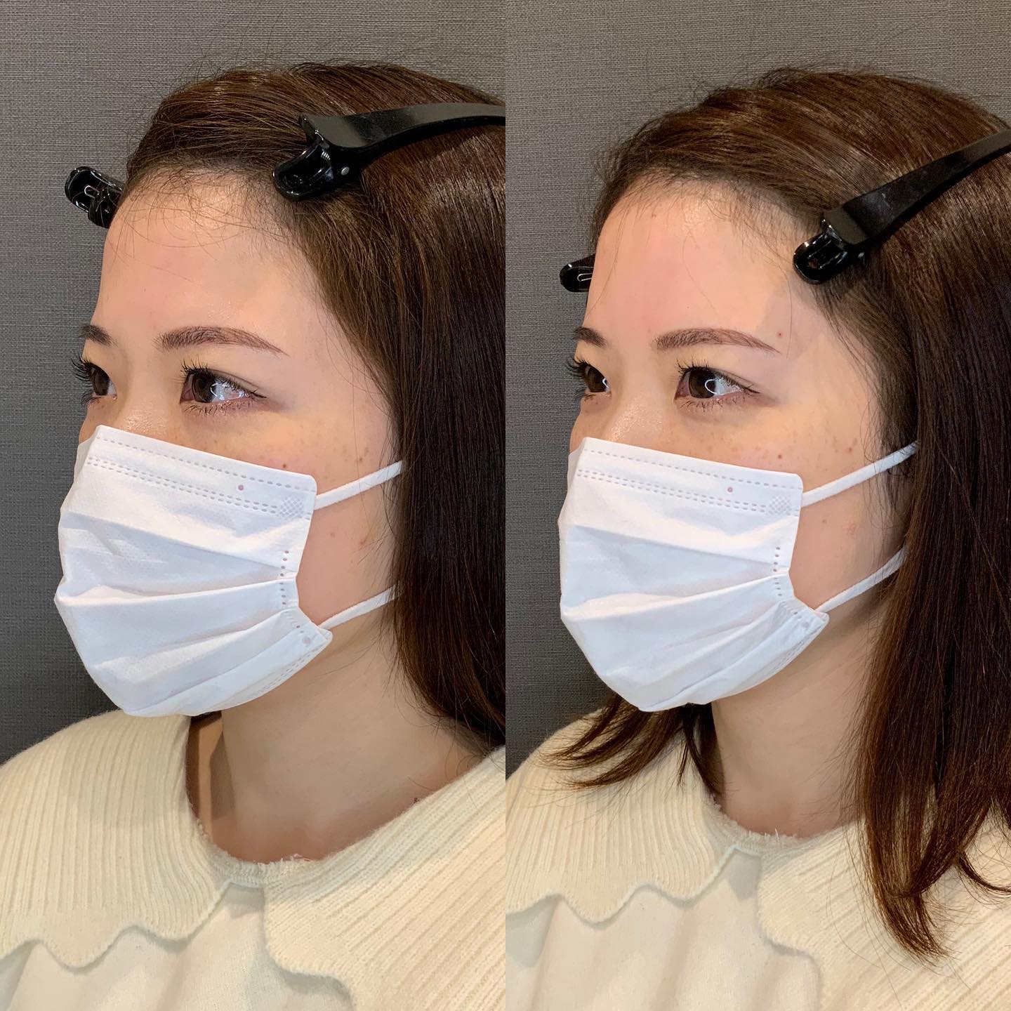 《ヒアルロン酸1.5cc✨》
