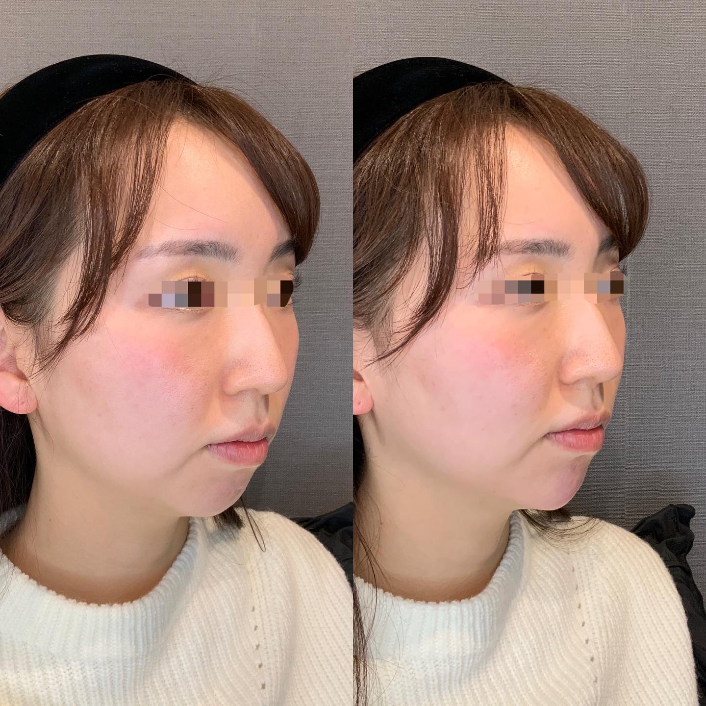 《ヒアルロン酸1cc✨》