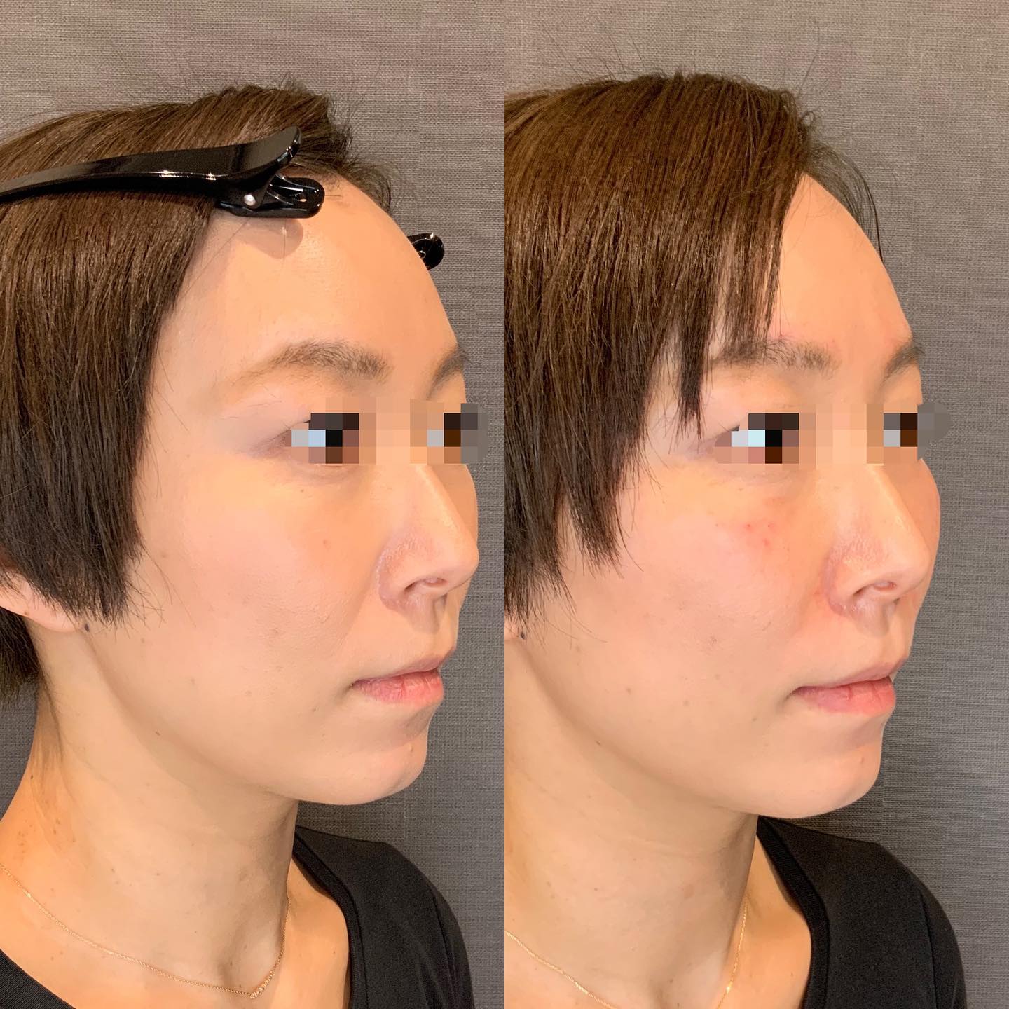 《ヒアルロン酸2cc✨》