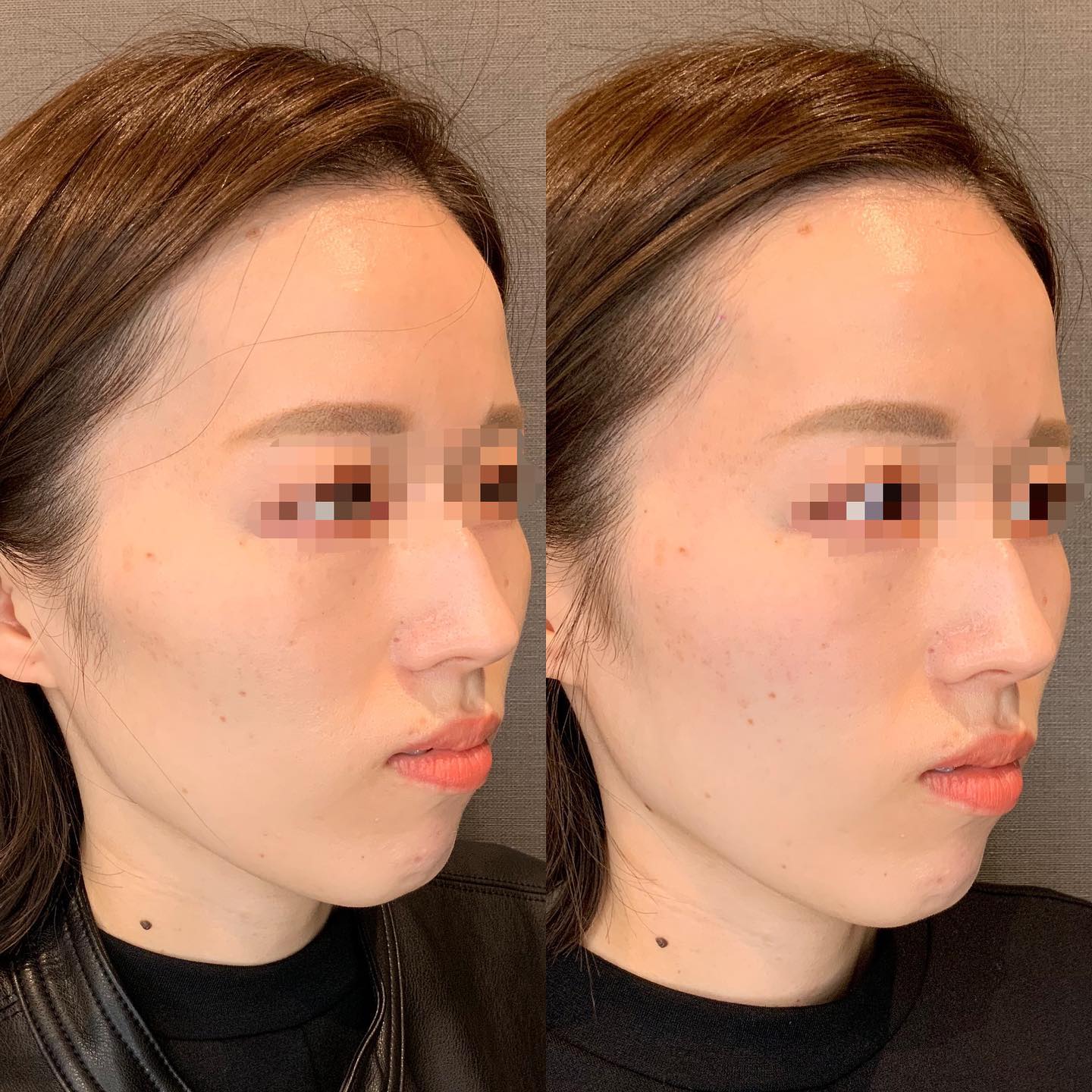 《ヒアルロン酸3cc✨》