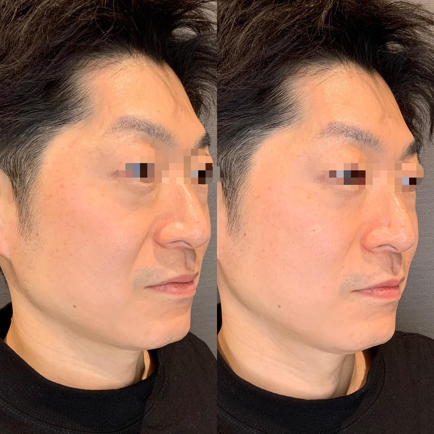 《ヒアルロン酸3cc✨》