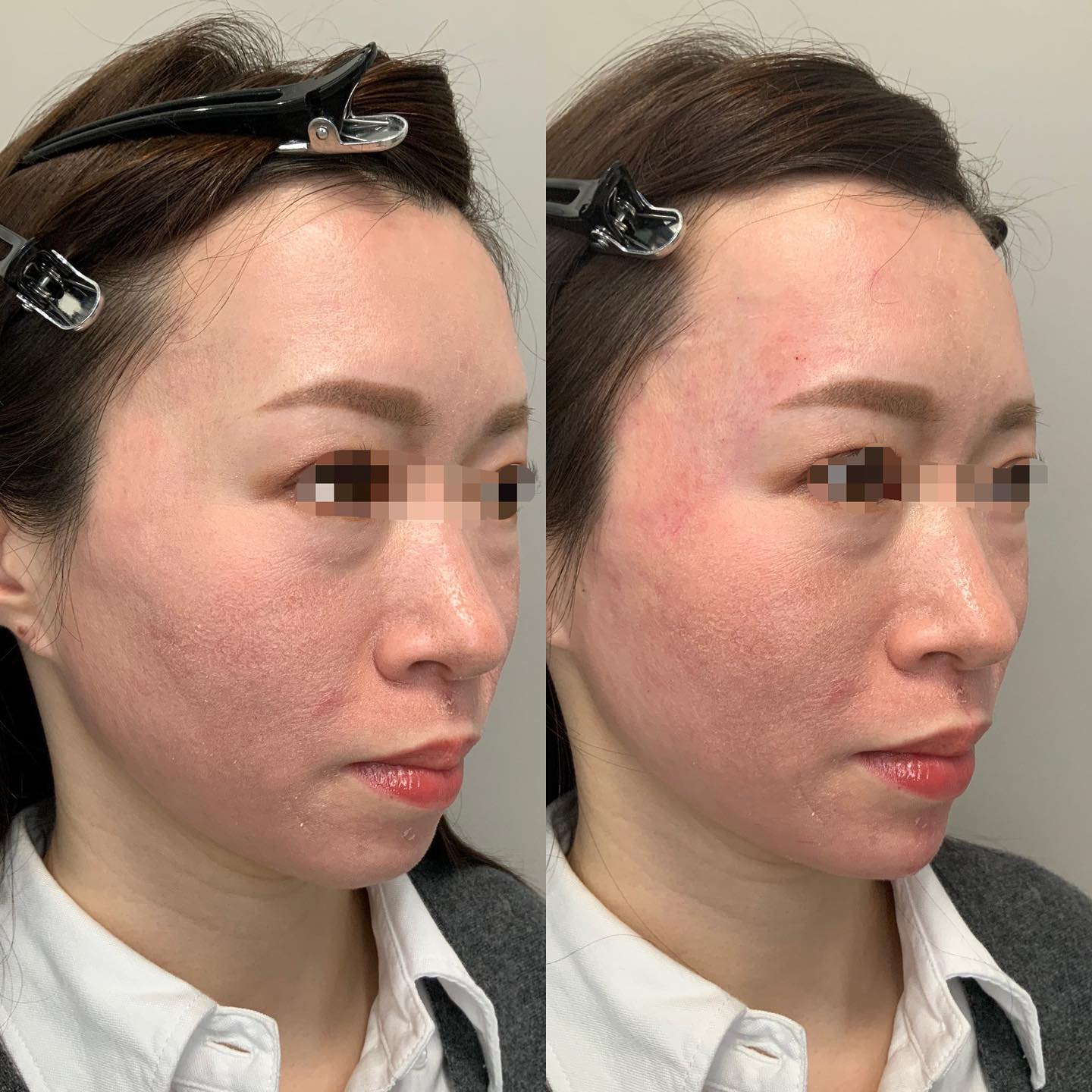 《ヒアルロン酸3.5cc✨》