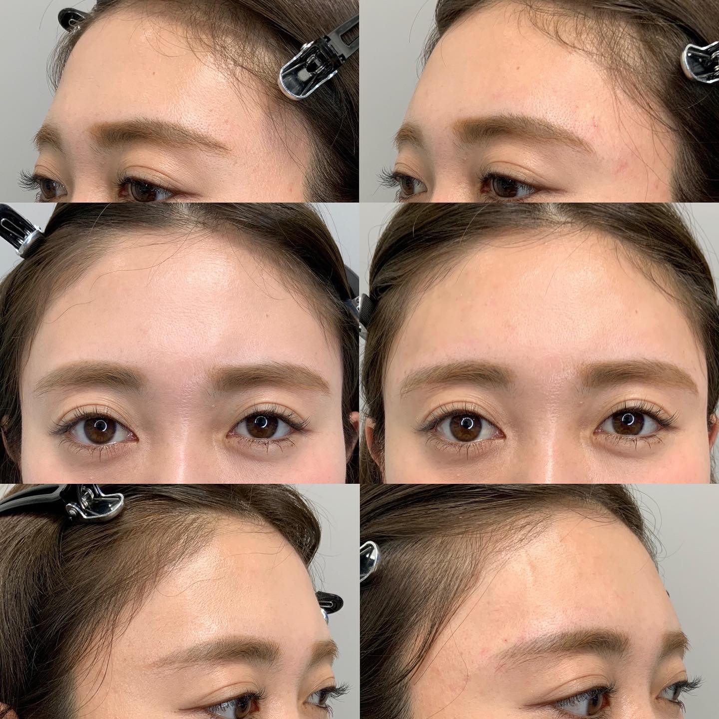 《ヒアルロン酸1.5cc✨》