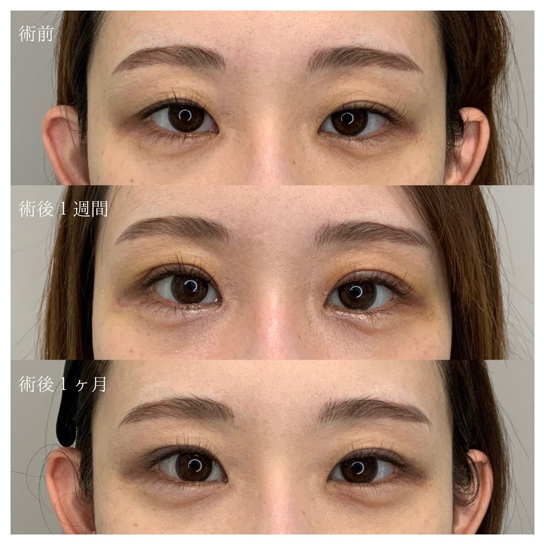術前と術後1ヶ月の写真です📷✨