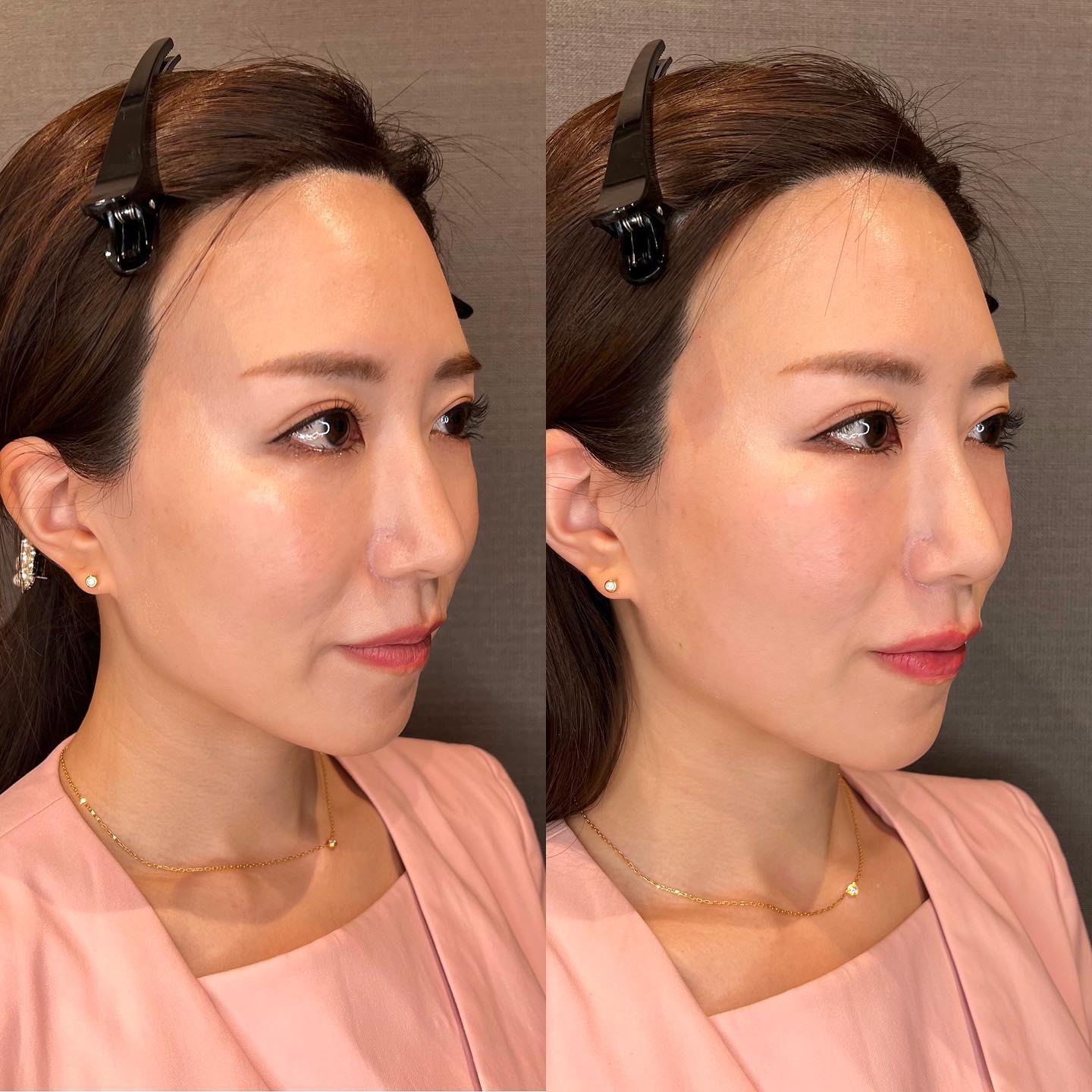 《ヒアルロン酸4cc✨》