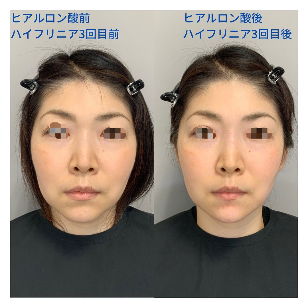 《ハイフリニア+ヒアルロン酸3cc》
