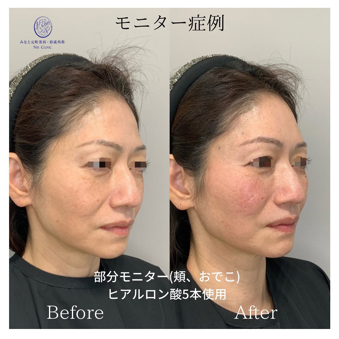 《ヒアルロン酸5cc》
