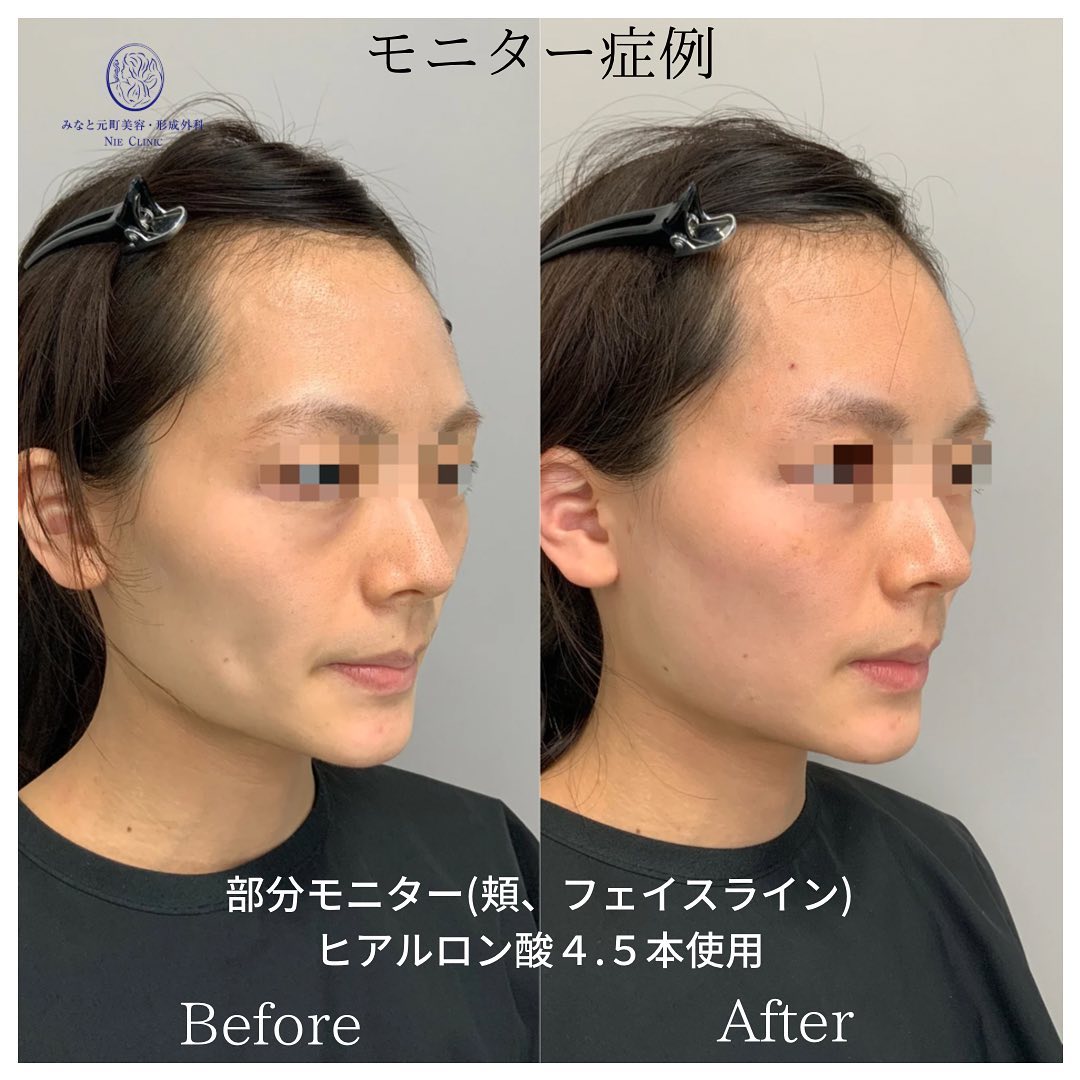 《ヒアルロン酸4.5cc》