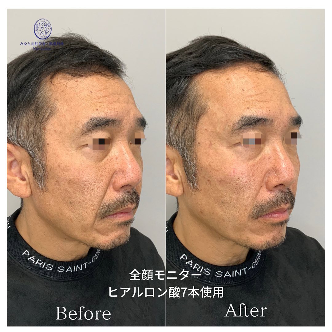 《ヒアルロン酸7cc》