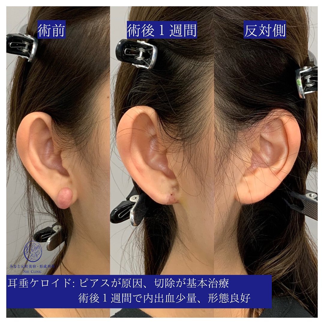 耳垂ケロイド